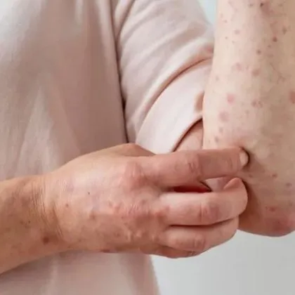 Откриха нови случаи на морбили