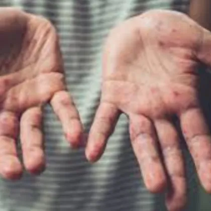 153 станаха случаите на морбили у нас