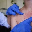 Болните от морбили вече са 328