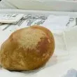 Лекари извадиха 3,1-килограмов камък от пикочния мехур на мъж СНИМКА