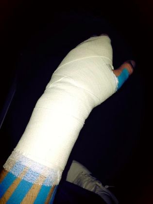 Счупена ръка и крак след два пътни инцидента