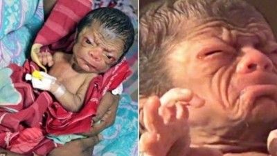 В Бангладеш се роди дете с лице на 80-годишен старец