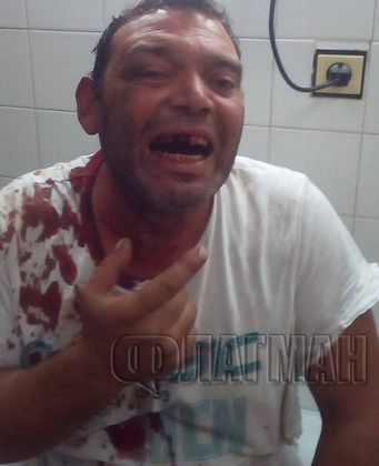 Озверели роми пребиха жестоко баща и син в Средец (СНИМКИ 18+)