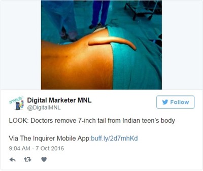 Лекари отстраниха 18-сантиметрова опашка на индиец, смятан за бог
