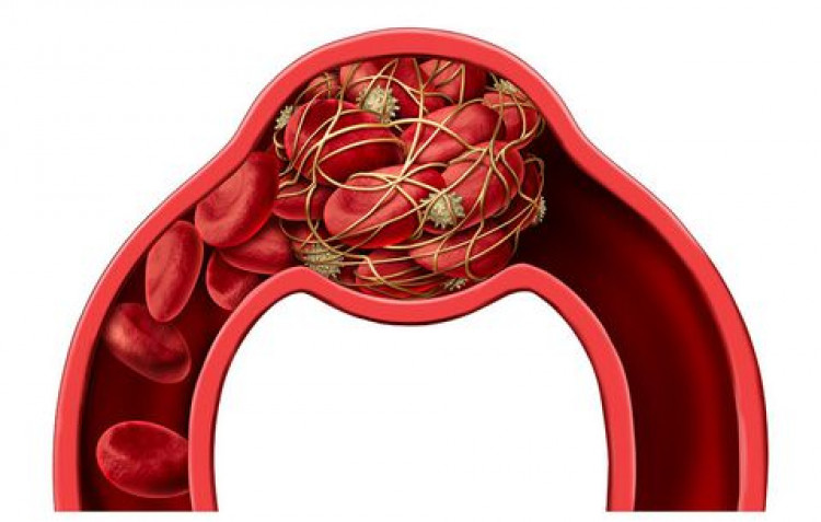Чрез тези признаци е възможно да се разпознае тромбозата в ранните стадии