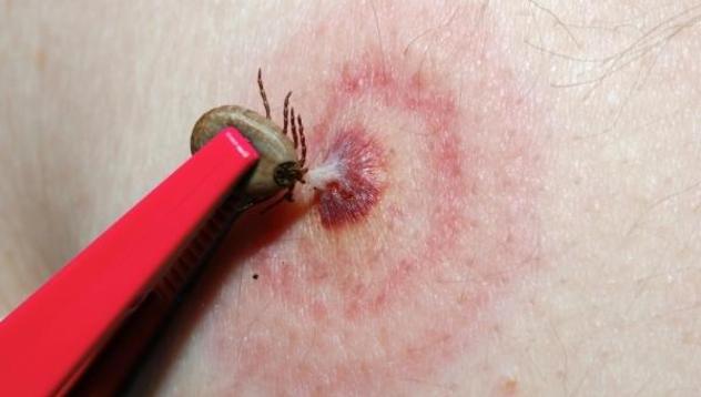 Става страшно! Първи случай на лаймска болест, още трима ухапани от кърлежи