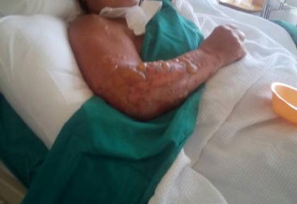 Кошмарна СНИМКА (18+) на обгорялата българка Елена в огнения гръцки ад!
