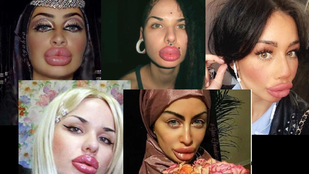 Вижте жените с най — грозните устни в света (СНИМКИ)