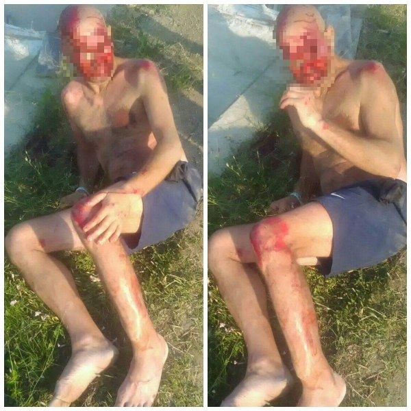 Мъж от пловдивско село е блъснатият край Слънчев бряг, с опасност за живота е СНИМКИ 18+