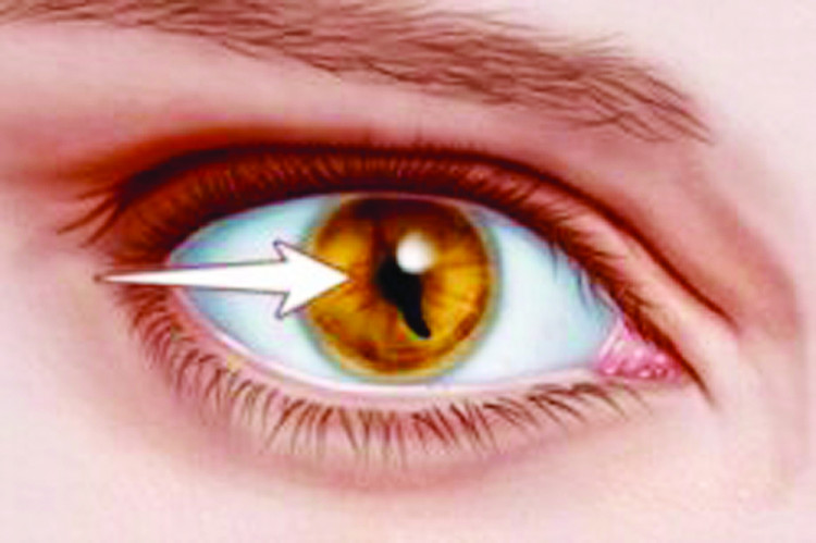 Доц. д-р Красимир Коев, д.м.: Синдромът на котешките очи е рядко хромозомно разстройство