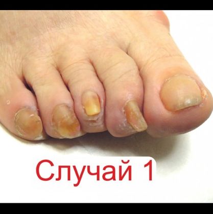 За такова лечение на гъбички по ноктите 100% не сте чували. Само една капка от това и край на мъките и дискомфорта