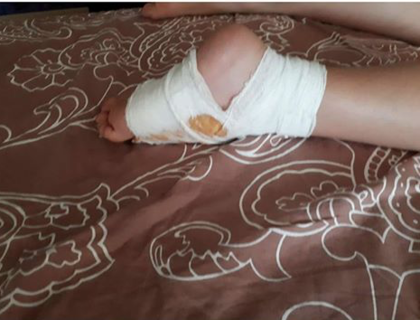 Питбул ухапа 6-годишно дете! Бащата: Почвам да коля псета СНИМКА