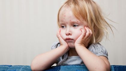 На вниманието на пловдивчани: 10 признака, че детето ви може би има морбили