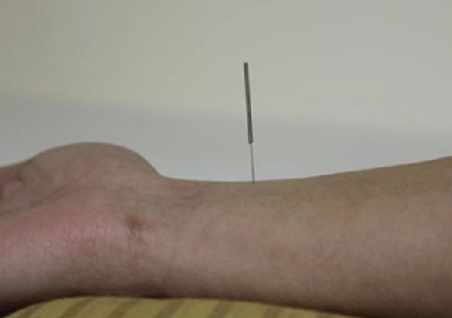 Китайска терапия „игла нож” лекува 60 болести