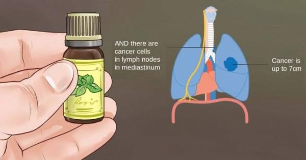 Истината за рака и етеричните масла от първа ръка, която НИКОЙ онколог няма да ви разкрие